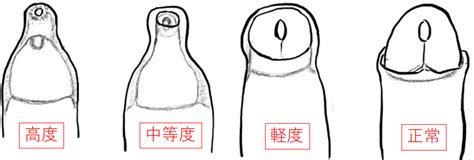 包茎とは？図で仮性・真性・嵌頓の見分け方をわかり。